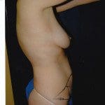 Tummy Tuck 32