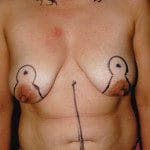 Tummy Tuck 29