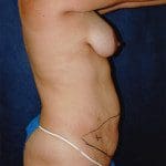 Tummy Tuck 27