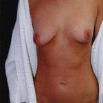 Breast Augmentation 55