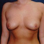 Breast Augmentation 54