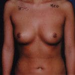 Breast Augmentation 52