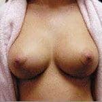 Breast Augmentation