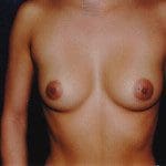 Breast Augmentation 50