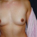 Breast Augmentation 49
