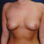 Breast Augmentation 48