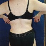 Liposuction