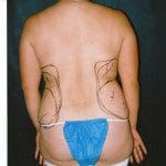 Liposuction 30