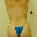 Liposuction
