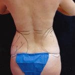 Liposuction 29