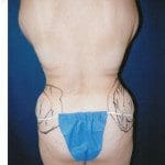 Liposuction 28