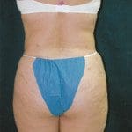 Liposuction