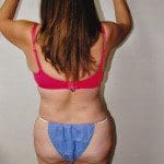 Liposuction