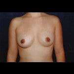 Breast Augmentation 31