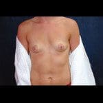 Breast Augmentation 29