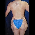 Liposuction 25