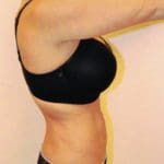 Liposuction